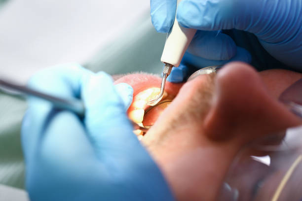 Best Emergency Treatment for Dental Infections or Abscesses in Churchville, PA